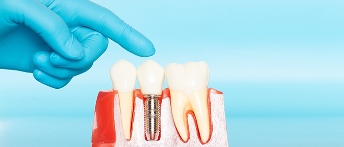 Dental implant dentists in West Michigan